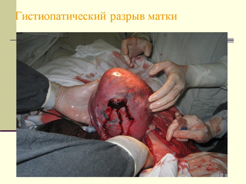 Гистиопатический разрыв матки